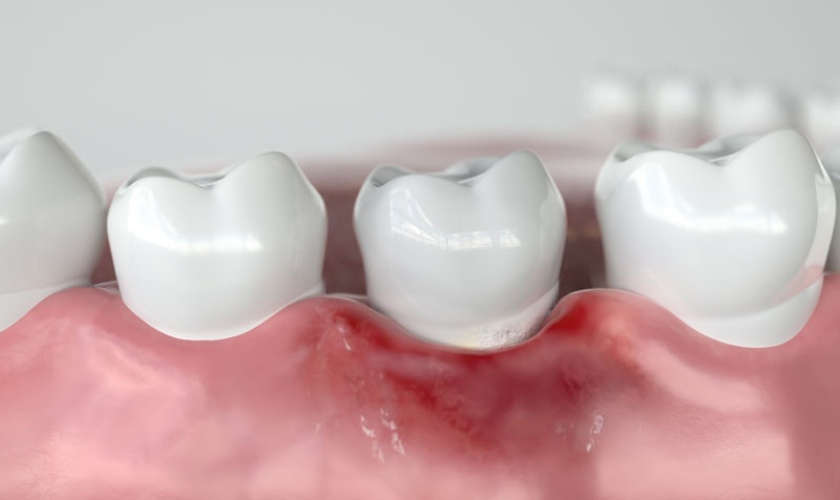 Nhiễm trùng vùng trồng răng Implant