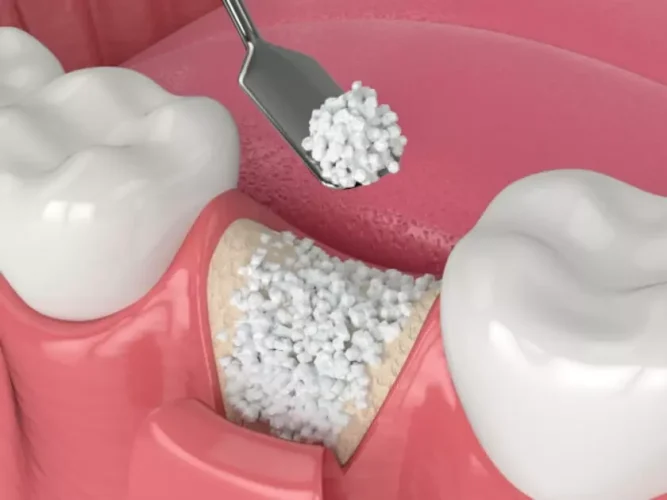 Bác sĩ chỉ định ghép xương chỉ khi xương hàm không đủ điều kiện cấy implant
