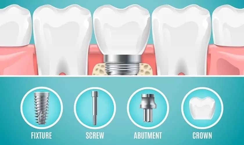 Bảng giá trồng răng phụ thuộc vào loại trụ Implant mà bạn lựa chọn
