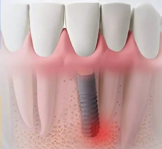 Cắm Implant không đúng vị trí gây nhiều hậu quả nghiêm trọng