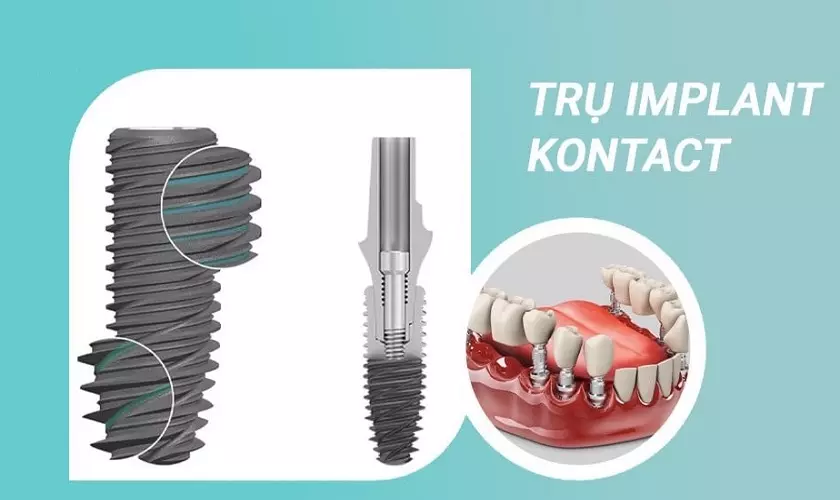 Cấu tạo đặc biệt của trụ Implant Tekka Kontact