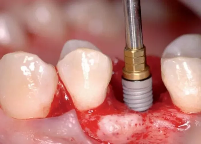 Thực hiện cấy ghép implant ở nha khoa không uy tín cũng là nguyên nhân khiến trụ bị nhiễm bệnh