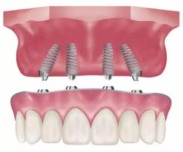 Cấy Implant có thể gây sưng sau phẫu thuật
