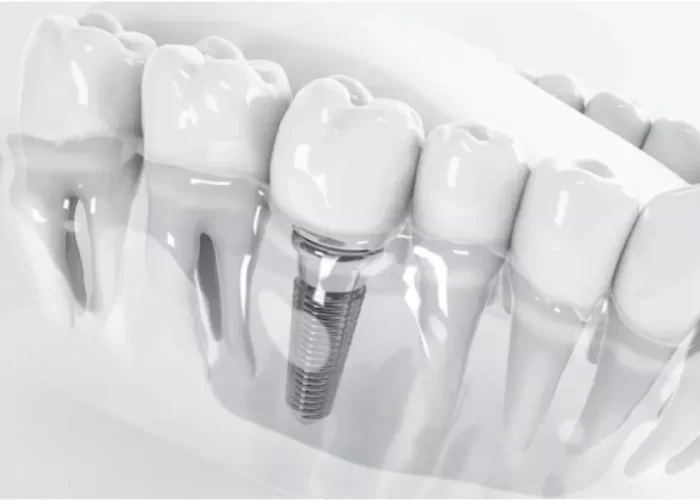 Chất lượng trụ implant được sử dụng cũng là yếu tố để đánh giá nha khoa đó có uy tín hay không?