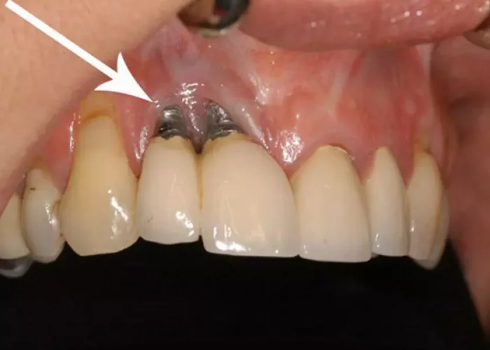 Dấu hiệu để nhận biết trồng răng implant thất bại là bị viêm nhiễm quanh trụ implant