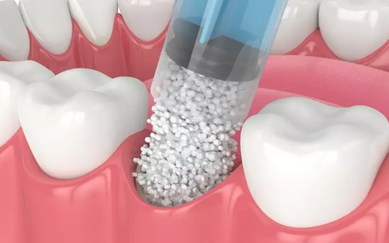 Ghép xương nhân tạo bao lâu trồng răng Implant