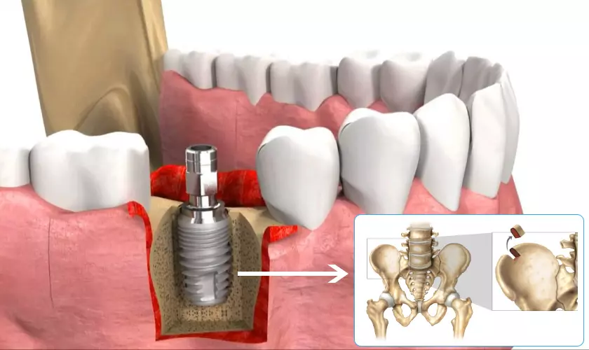Ghép xương trong cấy ghép Implant