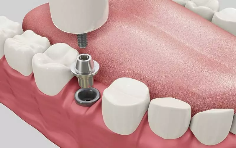 Giá trồng răng Implant có phù hợp cho mọi đối tượng