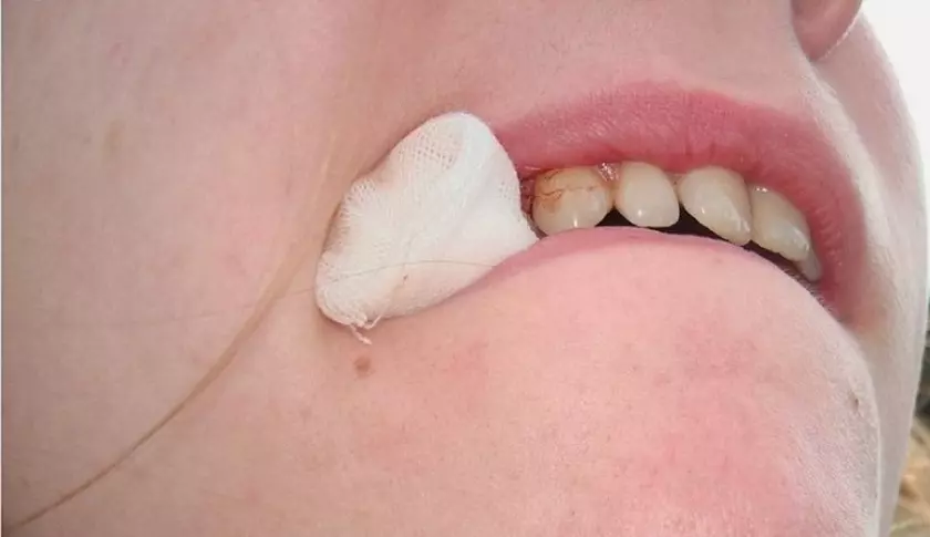 Cắn chặt miếng gạc vô trùng khoảng 30 phút sau phẫu thuật để cầm máu