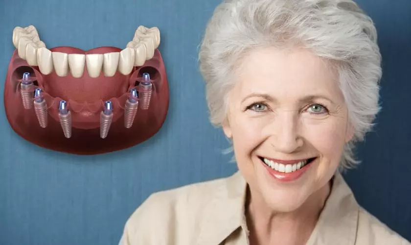 Implant All on 6 giúp tiết kiệm tối đa chi phí