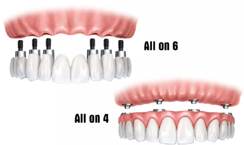 Implant Nobel Biocare Active phù hợp với cả phục hình răng toàn hàm All on 4, All on 6