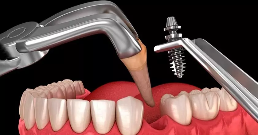 Implant Nobel Biocare Active thích hợp cho phục hình tức thì sau nhổ răng