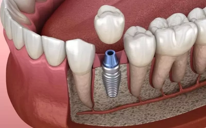 Khắc phục vấn đề dắt thức ăn khi trồng răng Implant
