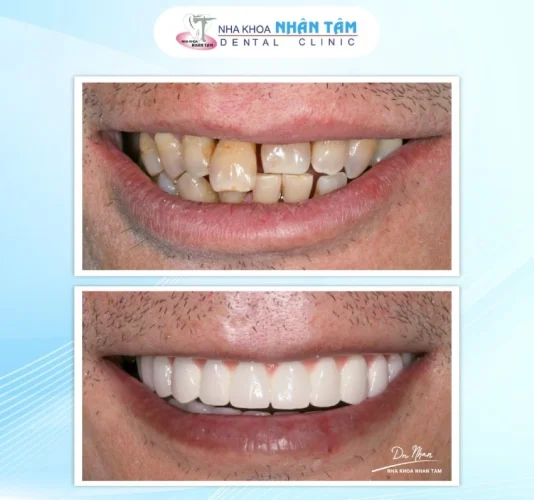 Khách hàng cấy ghép Implant tại Implant Center