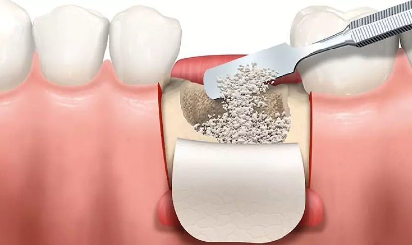Kỹ thuật ghép xương nhân tạo