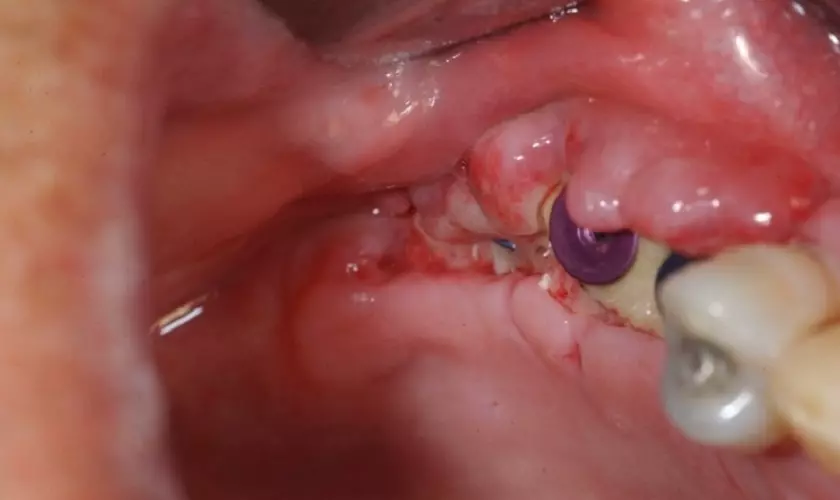 Nhiễm trùng khu vực răng Implant mới trồng