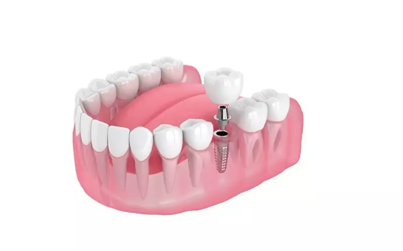Những trường hợp nào được bảo hành sau khi trồng răng Implant