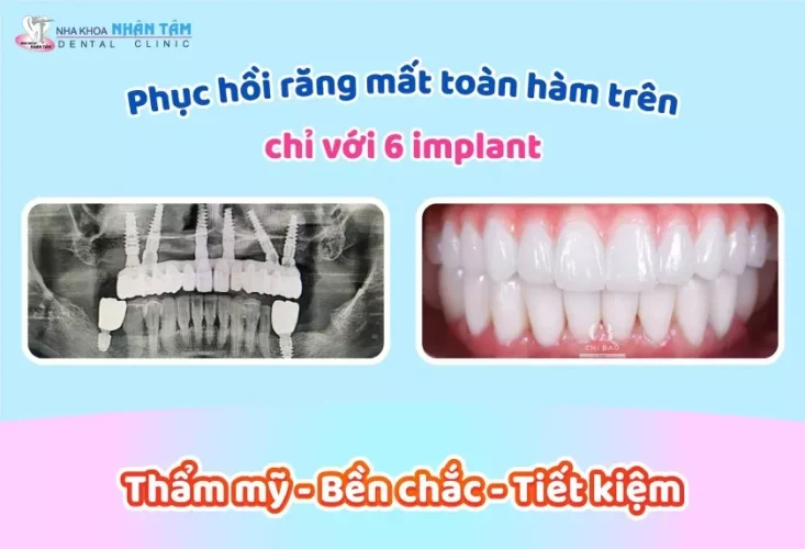 Răng Implant mang lại thẩm mỹ cao