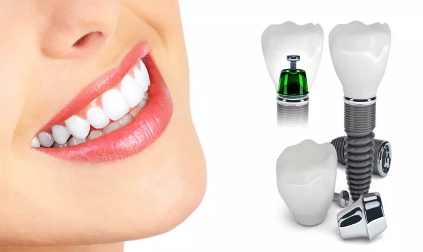 Răng Implant đem lại thẩm mỹ hài hòa và khả năng ăn nhai tốt