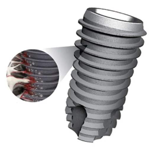 Thiết kế ren xoắn thông minh giúp Implant Hàn Quốc có độ ổn định cao khi cấy ghép