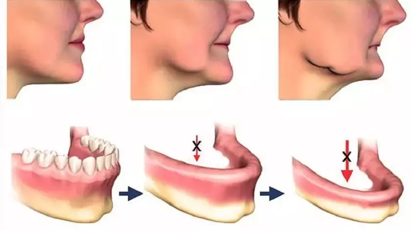 Thời gian điều trị dài hơn ở khách hàng bị tiêu xương
