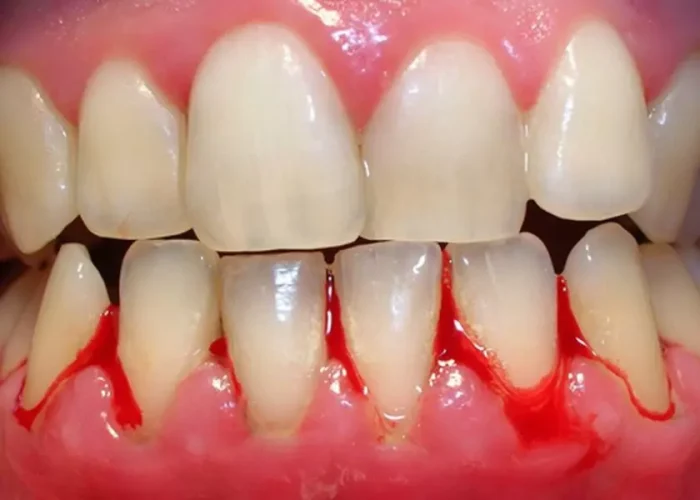 Tình trạng chân răng bị chảy máu kéo dài