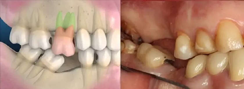 Tình trạng răng bị đổ nghiêng, sai khớp cắn nếu không phục hình răng mất trong thời gian dài