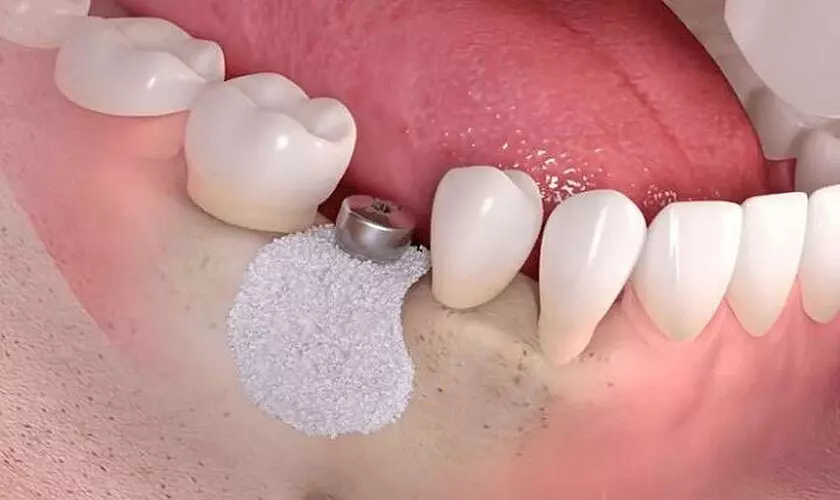 Tình trạng xương hàm cũng là yếu tố ảnh hưởng rất lớn đến độ bền của răng Implant