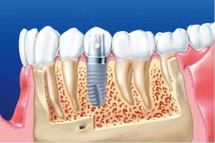 Trồng răng Implant đảm bảo ăn nha thẩm mỹ hiệu quả