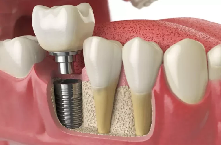 Trồng răng Implant là biện pháp điều trị tối ưu nhất cho người mất răng lâu năm