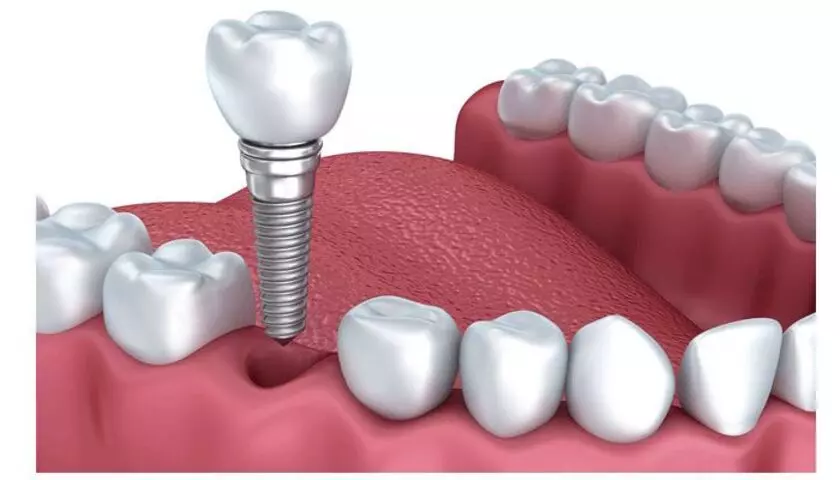 Trụ Implant đóng vai trò như 1 chân răng thật