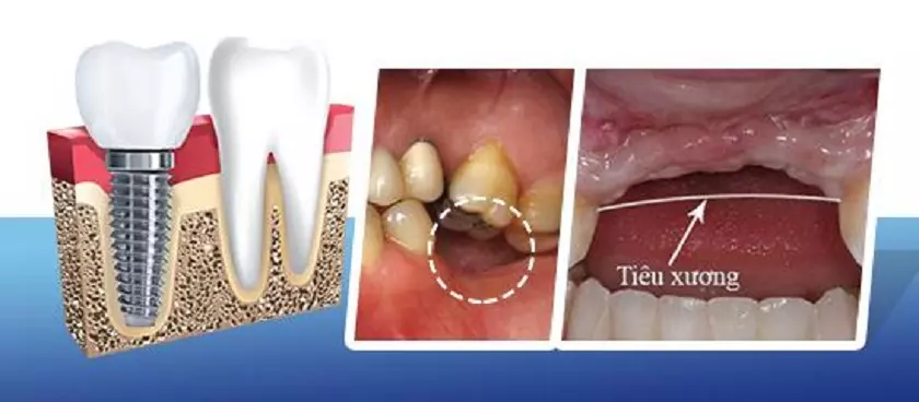 Trụ Implant Tekka Kontact giúp ngăn chặn hiệu quả tình trạng tiêu hủy xương hàm do mất răng