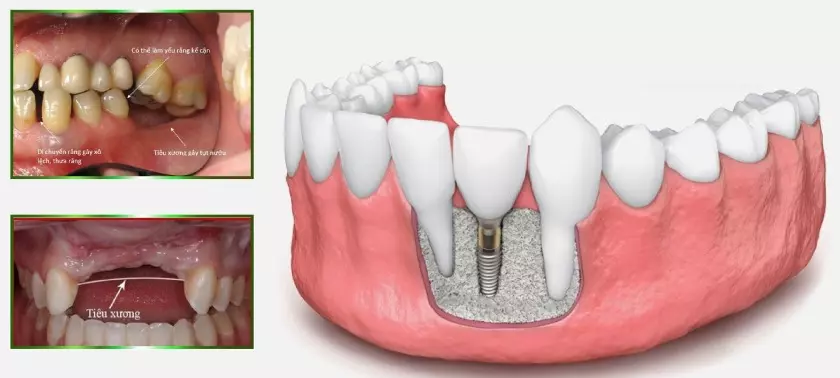 Trường hợp cần phải ghép xương