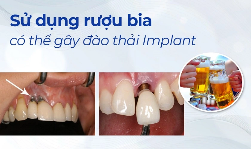 Uống bia rượu có thể làm tăng nguy cơ đào thải Implant