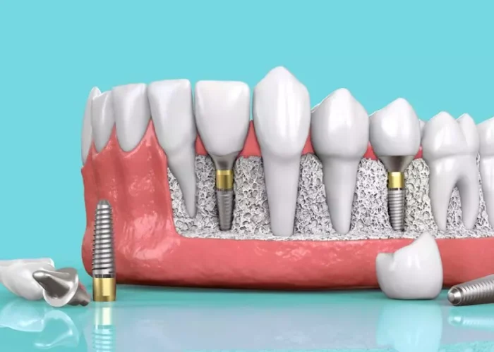 Viêm quanh trụ có thể khiến cho trụ implant bị lung lay và rơi ra ngoài
