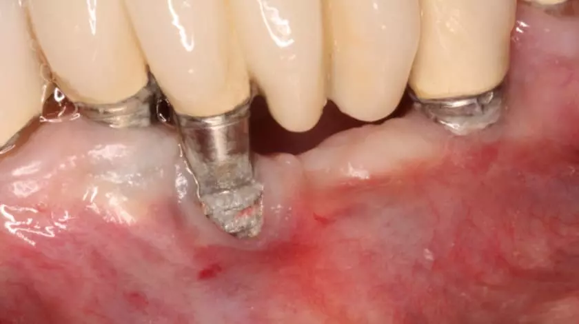 Vít abutment nằm giữa trụ Implant và răng sứ