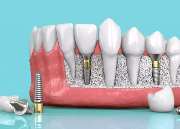Vô trùng dụng cụ là bước quan trọng trong quy trình trồng răng Implant