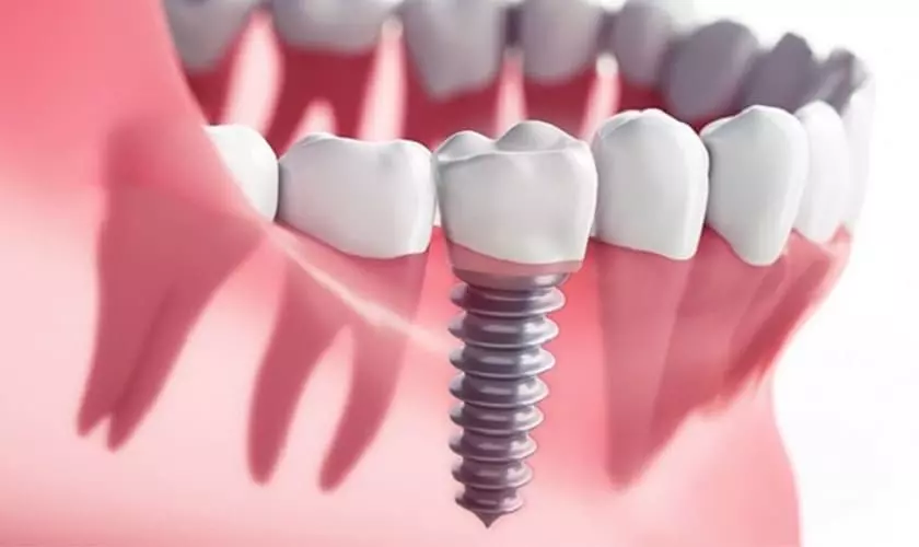 Vô trùng dụng cụ trong cấy ghép Implant giúp phòng tránh các bệnh lây nhiễm