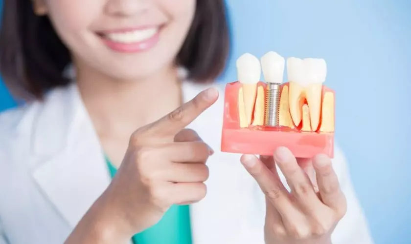 Bảng giá trồng răng Implant 2023 - implantcenter.vn