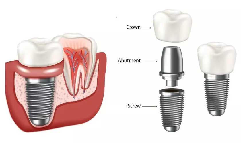 Bảng giá trồng răng phụ thuộc vào cấu tạo răng Implant mà bạn lựa chọn