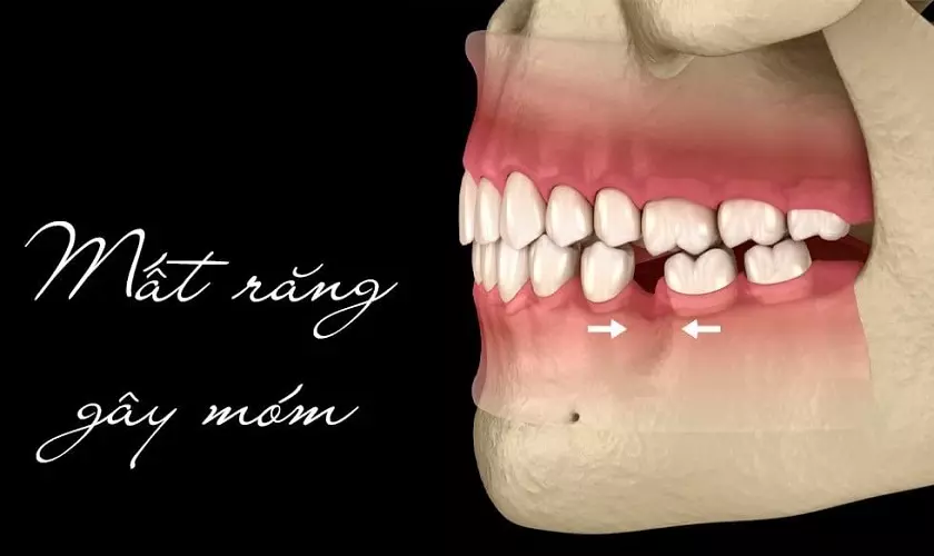 Bị móm do mất răng