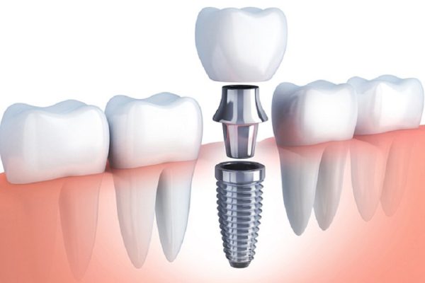 Trồng răng Implant