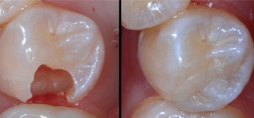 Trám răng được áp dụng khi răng hàm gãy không quá 1/3 thân răng