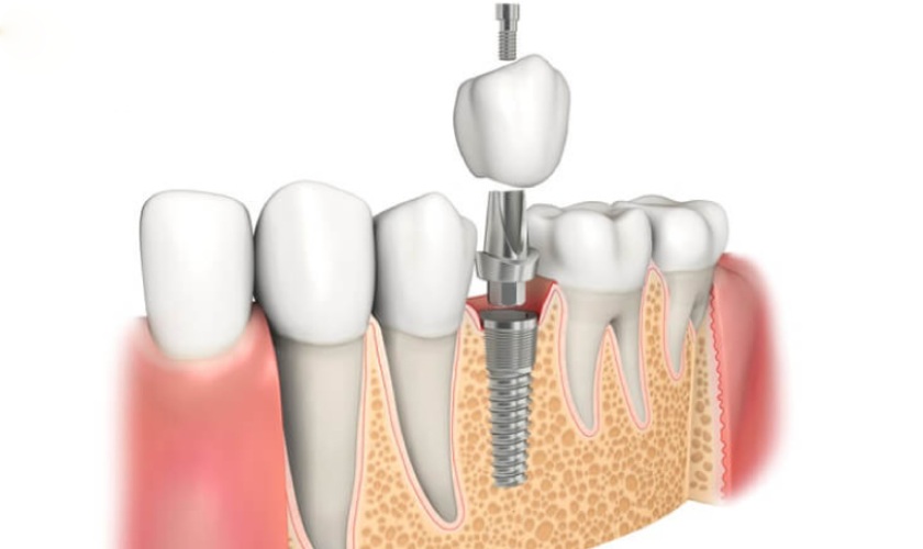 Cấy ghép Implant được chỉ định khi răng hàm bị gãy không thể bảo tồn