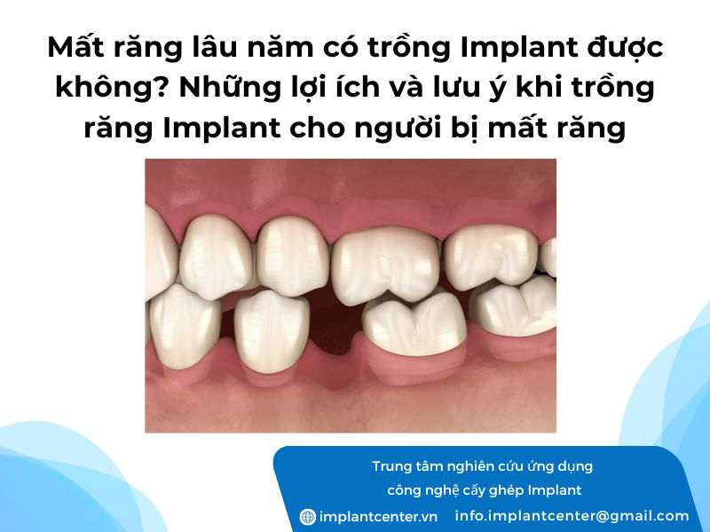 Mất răng lâu năm có trồng Implant được không? Những lợi ích và lưu ý khi trồng răng Implant cho người bị mất răng
