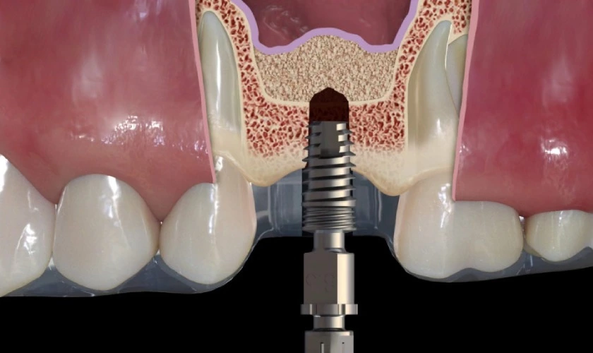 Nâng xoang trong cấy ghép Implant