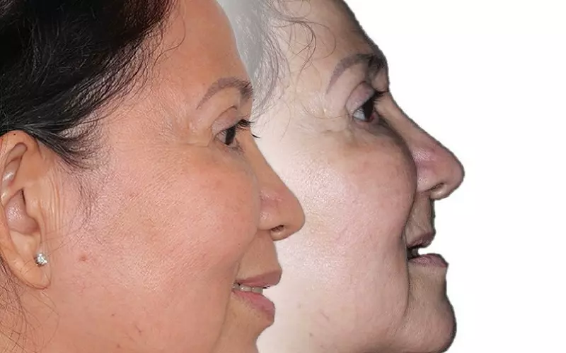 Thoát khỏi móp tóp khuôn mặt nhờ trồng răng Implant