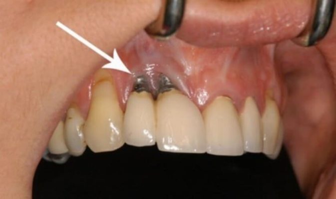 Răng Implant bị đào thải
