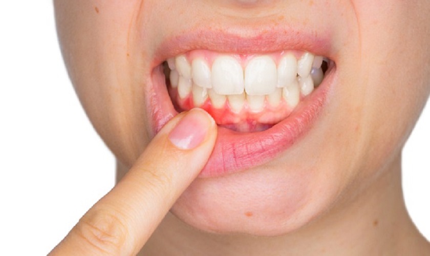 Dị ứng với chất liệu chế tác răng sứ, Implant có thể khiến răng Implant bị đau