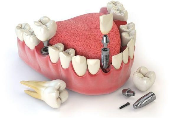 Răng Implant có tuổi thọ lâu dài